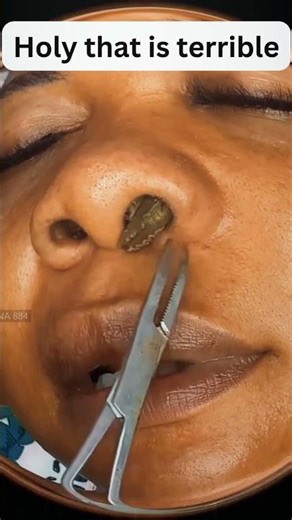 Quick pimple Explosion