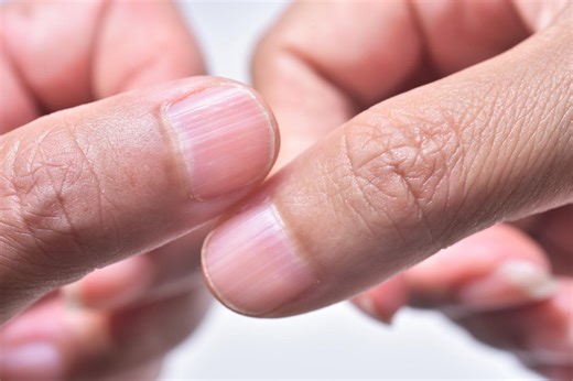 Here’s what it means if you have ridges on your nails