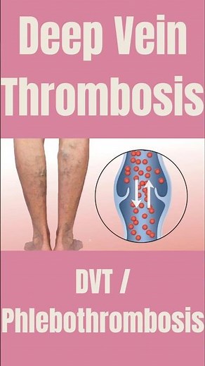Deep Vein Thrombosis Explained | Detect Early, Prevent Pulmonary Embolism #physiotherapist