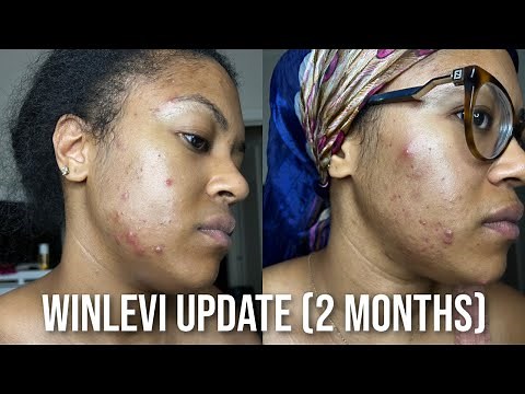 Winlevi Update/Experience (2 Months) [Before & After Acne Pics] + mini vlog w/ updates