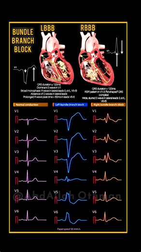 85K views · 557 reactions | Bundle Branch Block (LBBB & RBBB), detailing the conduction system, key causes, and ECG patterns.  Like |  Share |  Tag a colleague | ⏳ Save for later. #Cardiology #Lbbb #Rbbb #BundleBranchBlock #ECG | Abdallah Othman | Facebook