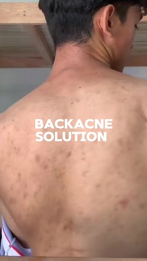 Effective Back Acne Treatment You Can Try Now