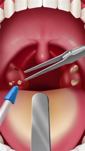 “Tonsil Stones: The Hidden Source of Bad Breath”