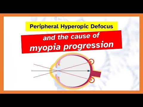 Peripheral hyperopic defocus and the cause of myopia progression explained