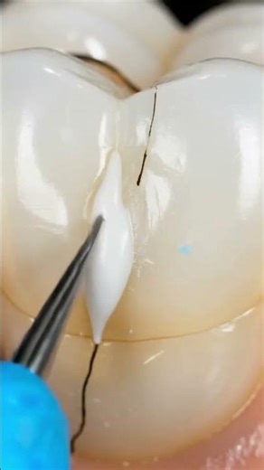 Dantle care. #dentist #satisfying #experiements #piercing