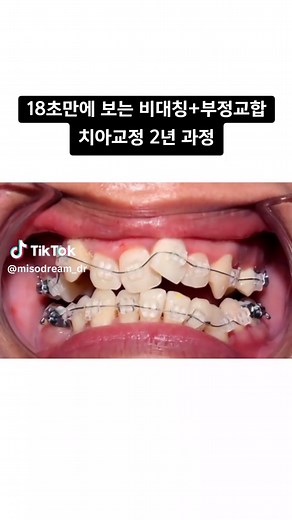 교정 치료로 덧니와 얼굴 비대칭 해결하기