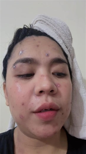 Recovering from Chicken Pox with Scarminator Cream