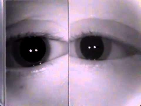 Duane's Retraction Syndrome Type 3