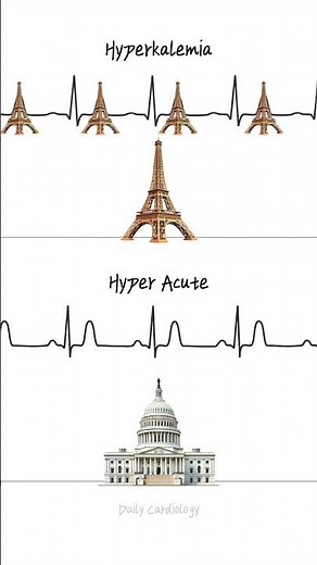 The difference between Hyperkalemia ECG and Hyper Acute T wave ECG #ecg #cardiology