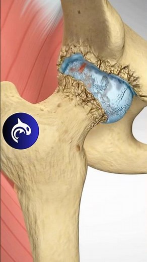 Hip Osteoarthritis - 3D Animation
