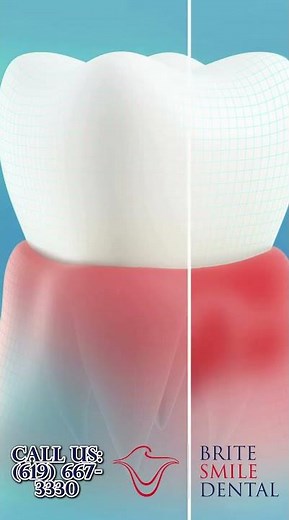 Gingivitis vs. Periodontitis: What's the Difference? | Brite Smile Dental