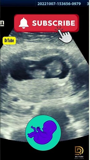 Fetal ultrasound of 10 weeks 6 days _ Mother thinks it's baby boy moving #pregnancy #ultrasound #yt