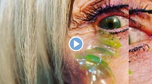 Viral Video: महिलेच्या डोळ्यातून निघाले २३ कॉन्टॅक्ट लेन्स; कारण ऐकून डॉक्टरही चक्रावले