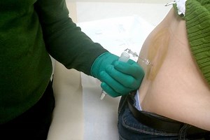 Lumbar puncture: what is a spinal tap? | Emergency Live