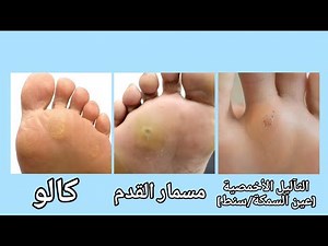 عيادة الجلدية - حلقة ٢١ - الفرق بين الثآليل (عين السمكة/السنط) ومسمار القدم والكالو