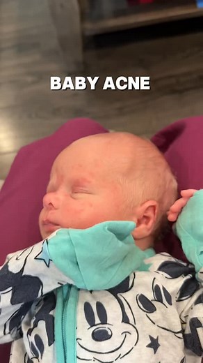 1.5K views · 29 reactions | If your newborn has little bumps on their cheeks, it’s probably baby acne — harmless + usually gone by 4–6 weeks | Happilyevansafterall | Facebook