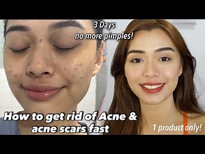 PAANO NAWALA PIMPLES KO IN 3DAYS ONLY! GOOD FOR ALL TYPES OF SKIN (NOT SCAM, JUST LEGIT!!)
