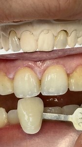 1.5K views | Lateral Amber Press Incisors! Case from Dr. Omar Cruz in Puerto Rico! HASSBio Hassambassador Kr #HASSBIO #hassambassador_kr | Luke Kahng | Facebook