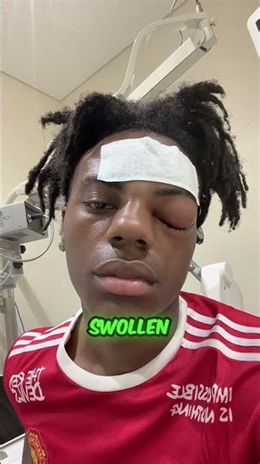 IShowSpeed Hospitalized? The Truth Behind His Swollen Eye