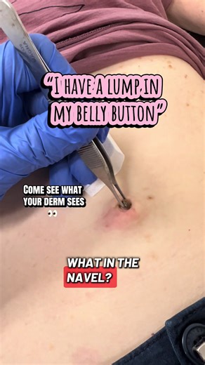 What in the navel?! ⚠️ Come see what your derm sees. 👀 This little surprise is called an omphalolith — also known as a navel stone. 🕳️ It’s a buildup of keratin, sebum, and debris that slowly compacts inside the belly button over time. When it’s ready to come out, it can often be gently extracted in clinic. Oddly satisfying… but definitely not a DIY situation. If something seems stuck in your umbilicus, let a licensed medical professional handle it safely. Educational content. Patient consent 