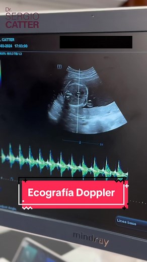 ¿Para qué sirve hacerse una ecografía Doppler?
