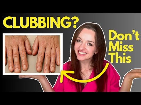 How to Examine for Finger Clubbing (And Actually Remember the Causes)