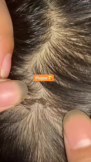 171K views · 695 reactions | Masih lanjut #Asmr #omg #lice | May Nurmy | Facebook