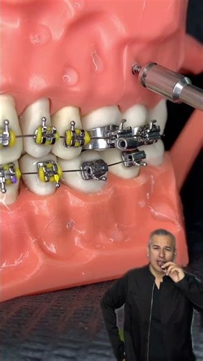 🔥Instalación de Micro-Tornillo de Ortodoncia🔥