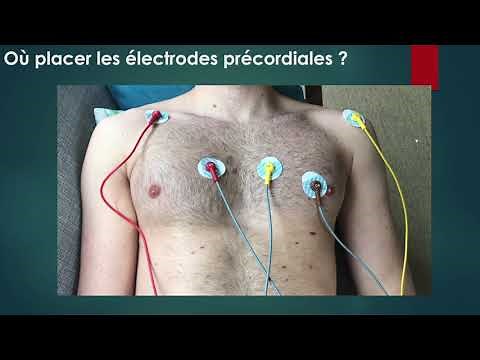 Réalisation d'un ECG et bon positionnement des électrodes_les chats noirs du 3SM
