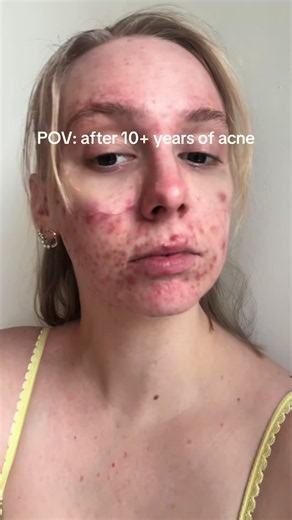 Anua Azelaic Acne Serum review: gentle azelaic acid for acne scars