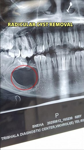 Radicular Cyst : Cyst in Lower Jaw | Removal of Jaw Cyst by Maxillofacial Surgeon