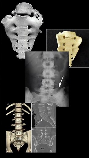 Sacralization of l5 vertebra!#physiotherapy