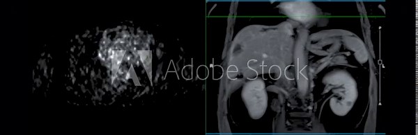 PET MRI of the liver provides detailed imaging for detecting liver abnormalities, aiding in diagnosis and treatment planning.