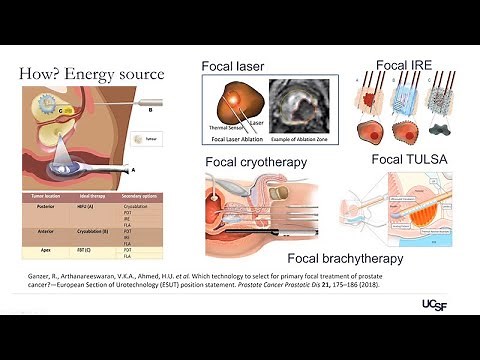 Focal Prostate Cancer Ablation: A Less Morbid Alternative to Surgery and Radiation