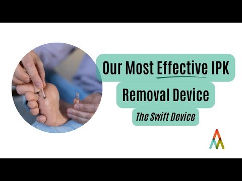 How We Treat IPK’s - Hidden Warts Inside Painful Calluses