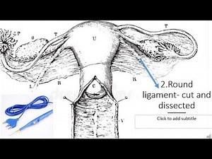 Learn how to perform a hysterectomy in 10 steps | Gynaecology made easy