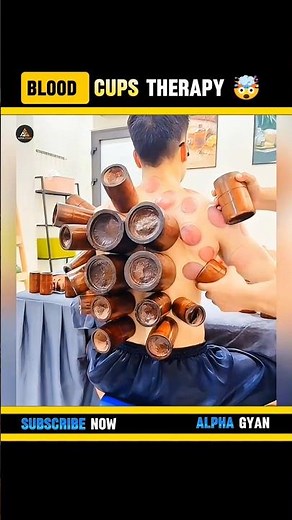 Cupping Therapy Benefits 🤯#shorts