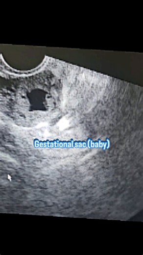 Sometimes a pregnancy starts in the wrong place — that’s called an ectopic pregnancy. It can be serious, but early detection can make all the difference. Here’s what every woman should know when pregnant Watch out for: Lower abdominal or side pain Spotting or bleeding Dizziness or fainting #WomensHealth #EctopicPregnancy #gynecare #gynaecologist #laparoscopy #pregnancy | Birth & Breath Clinics