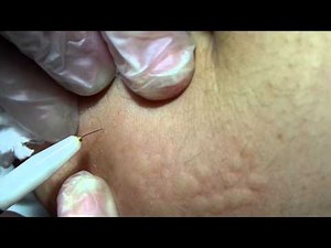 Electrology: Multiple Pulses Technique