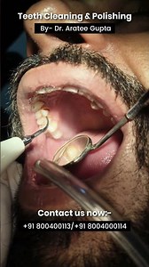 Teeth Cleaning & Polishing Step-by-Step#shorts