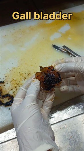 Gall bladder specimen 😳😣| #histopathology #gallbladder #gallbladderdisease #gall #gallstonetreatment