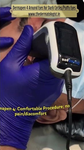 dermapen 4 eyes for Dark Circles