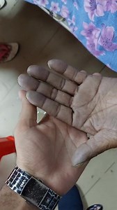Peripheral Cyanosis & Clubbing | Dr. Khaled Hasan Milu
