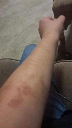 One month update on my arm lol Like Dayyumm it was sooo bad but almost fully healed!! A few weeks ago I went to a convenience store and the cashier grabbed my hand and said love is not supposed to hurt ma! 😂😂😂 I was like that's exactly what he told me you should see him lol But I told him I was jk, I was like being broke hurts lol I tried to give plasma for money! Like I don't want to do any of things I've been doing to make money BUT I'm gonna do what I gotta do to keep afloat! Hopefully thi