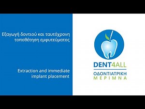 Εξαγωγή δοντιού και ταυτόχρονη τοποθέτηση εμφυτεύματος - Χειρουργείο Νο 1