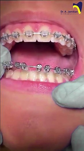 Debonding in orthodontics #orthodontics #orthodontist #brace #Debonding #bonding #bracket #wire