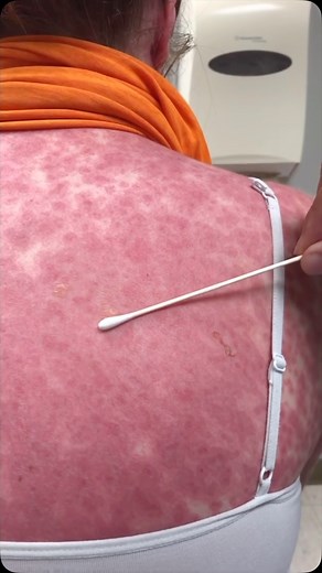 Truescienza on Instagram: "Una donna di 28 anni ha manifestato improvvisamente febbre elevata e lesioni cutanee diffuse in seguito all’assunzione di un antibiotico. Le lesioni coinvolgono oltre il 30% della superficie corporea. È presente il segno di Nikolsky. A)Necrolisi epidermica tossica (NET) B)Sindrome di Stevens-Johnson C)Dermatite esfoliativa D)Eritema multiforme"