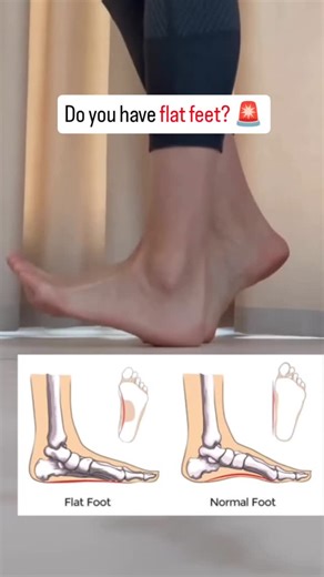 Flexifyme Physiotherapy & Pain Management on Instagram: "Struggling with flat feet? 🚶‍♀️ These 4 simple exercises can help strengthen your arches, improve foot posture, and reduce pain! Try them daily for better support and stability. ✅ . . #flatfeet #foothealth #strongfeet #posturecorrection #painrelief flat feet | foot posture | arch support | physiotherapy | foot strength | pain relief | mobility | exercise | balance | stability"