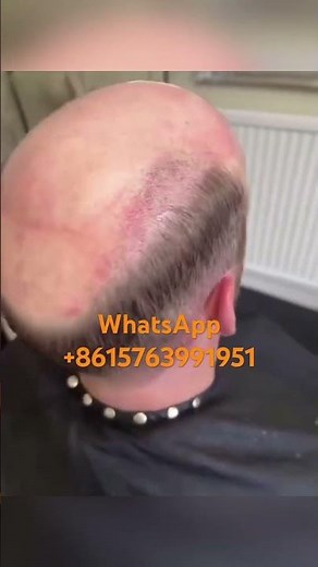 Tired of waiting weeks for a toupee? Lyrical Hair ships in 24hrs, delivers in 3 days-100% human hair