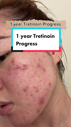 1 Year Tretinoin Progress Journey